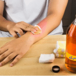 درمان گال با سرکه