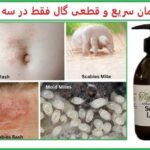 درمان گال با کرم پرمترین