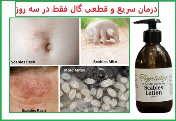 درمان گال با کرم پرمترین