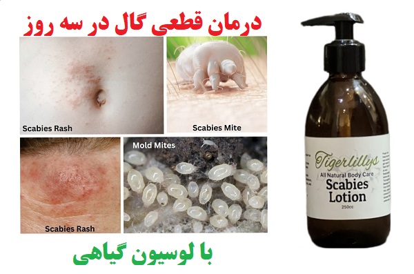 علت بیماری گال چیست؟ و روش پاکسازی فوری و کامل بدن از گال - پاکان مروارید