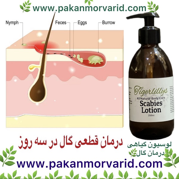 درمان گال در طب سنتی