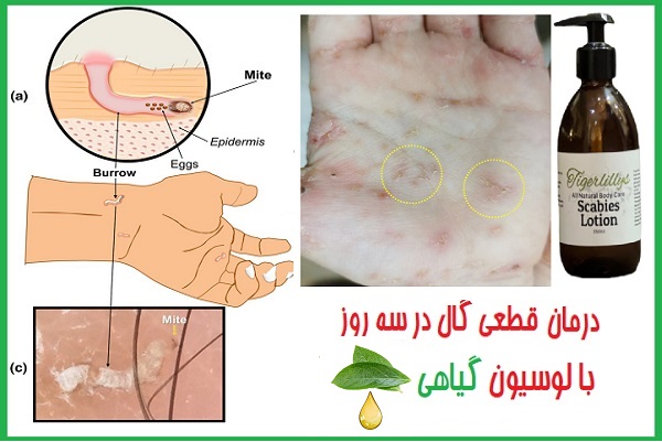 آیا بیماری گال خطرناک است