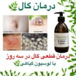 درمان گال افغانستان