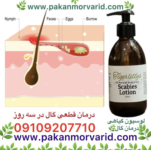 درمان قطعی گال