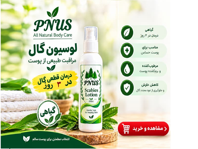 لوسیون درمان گال
