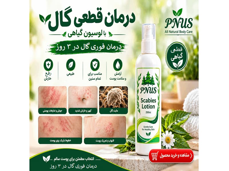 لوسیون درمان گال PNUS | لوسیون ضد گال